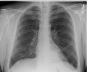 Zapalenie płuc – jakie są jego objawy i jak je leczyć?