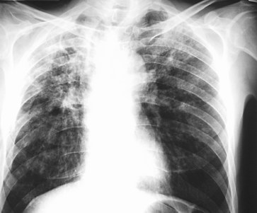 Zapalenie płuc – jakie są jego objawy i jak je leczyć?
